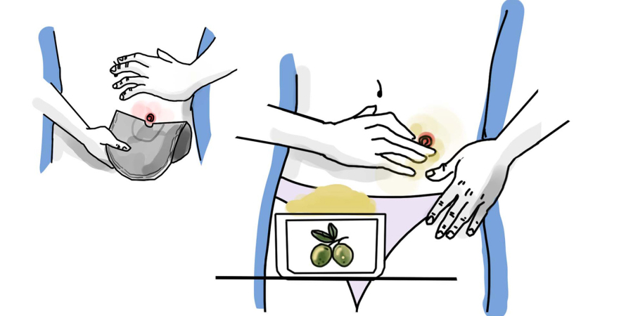 Ilustración de la aplicación del producto en pacientes.